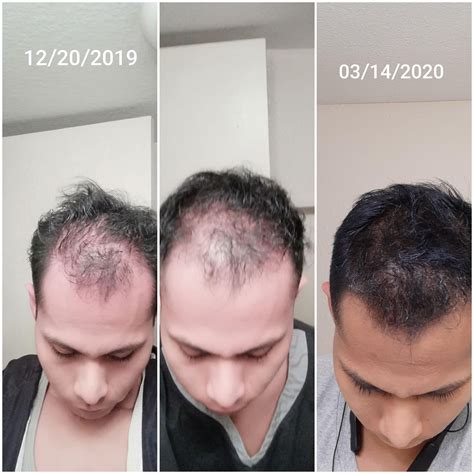 Dont wanna go all out blasting gear off the roof, hence starting with low dose. . Finasteride on steroid cycle reddit